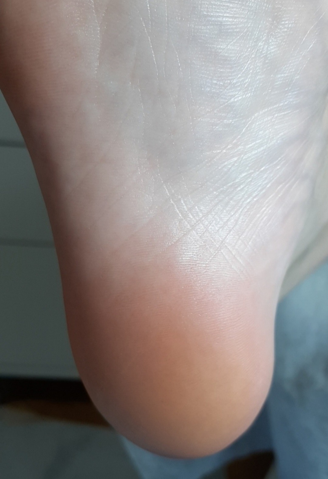 Smooth, soft heel after callus care